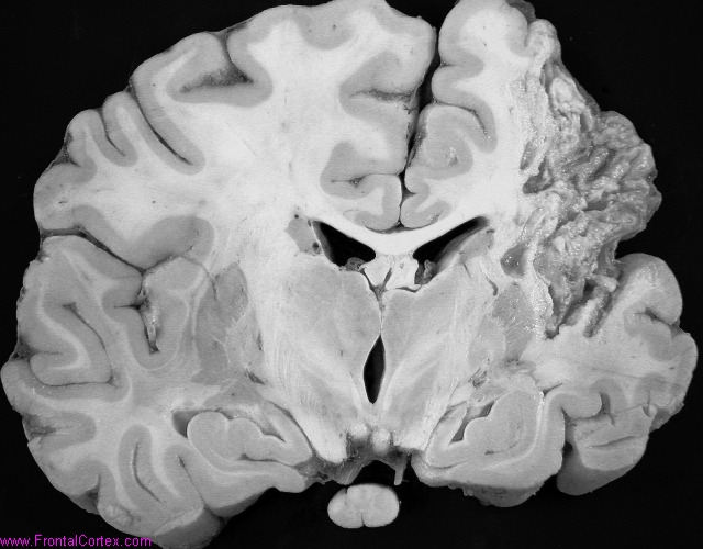 Cavitating middle cerebral artery infarct with secondary corticospinal tract degeneration